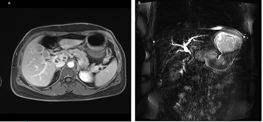 (A) Axial-T1w view with contrast: findings correlating with the CT and (B) magnetic resonance cholangiopancreatography showing a signal interruption of the CBD due to obstruction.