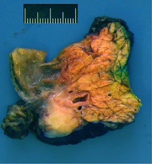 Macroscopic view: anterior surface of the pancreatic head (6 x 4 x 3.5 cm size).