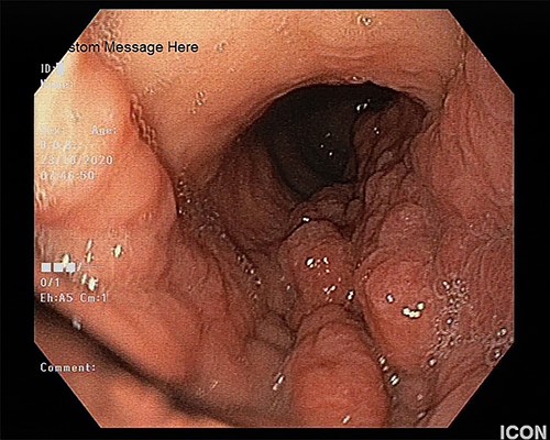 The upper endoscopy shows the thickened gastric folds and the nodular and edematous mucosa.