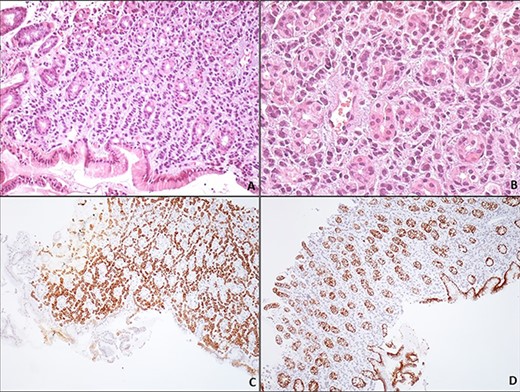 Gastric metastasis of lobular breast carcinoma. Gastric biopsy of the corpus region reveals a carcinoma arranged loosely in a linear pattern throughout the stroma between the gastric glands (A, H/EX200). The neoplastic cells are small, uniform, round with minimal pleomorphism; the nucleus has evenly dispersed chromatin and no nucleoli (B, H/EX400). Immunohistochemically, the neoplastic cells are positive for keratin 7 (C, H/EX10) and negative for E-cadherin (D, H/EX10).