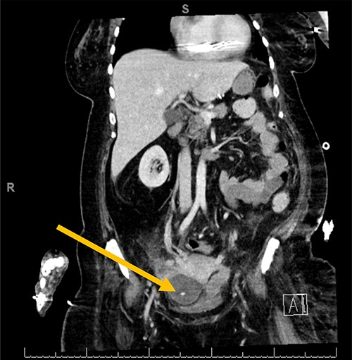 Pelvic abscess surrounding gastric band tubing.