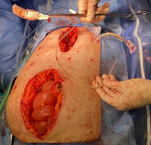 Gastric band and tubing removed after laparotomy.