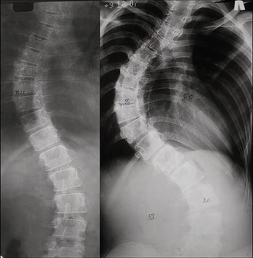 AP X-rays of the patient’s spine. (a) At 11 years old in standing position. A 43° main thoracic curve is visualized. (b) At a 1-year follow-up (12 years old, standing position). A main thoracic curve of 88° and a lumbar curve of 52° are visualized.