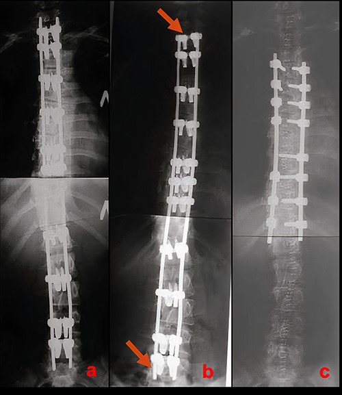 Radiographic results of surgical treatment. (a) AP X-rays of the patient’s spine in standing position after the 1st stage of surgical treatment on the 5th day after surgery. Residual deformity of the spine was 15°. (b) AP X-ray of the patient’s spine in a standing position 4 years after surgery. Growth of the spine and the associated shortening of the free upper and lower ends of the plates can be observed (red arrows). (c) AP X-ray of the patient’s spine after the 2nd stage of surgical treatment. The angle of residual deformity is < 5°.
