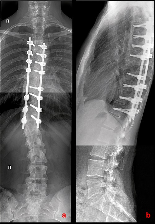 X-rays of the patient’s spine at a 10-year follow-up. (a) AP X-ray of the spine in standing position. There is a slight increase in the lumbar curve. (b) Lateral X-ray of the spine in standing position.