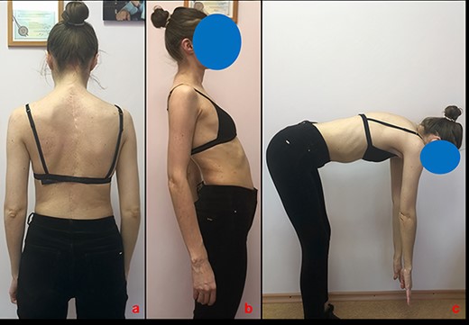 Appearance of the patient and the range of motion in the spine at a 10-year follow-up. (a) View from the back. (b) Side view in spinal extension. (c) Side view in spinal flexion.