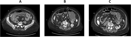 CT enterography: axial views demonstrating dilatation of the bowel loops in the left lower quadrant associated with bowel thickening and collapsed small bowel loops distally.