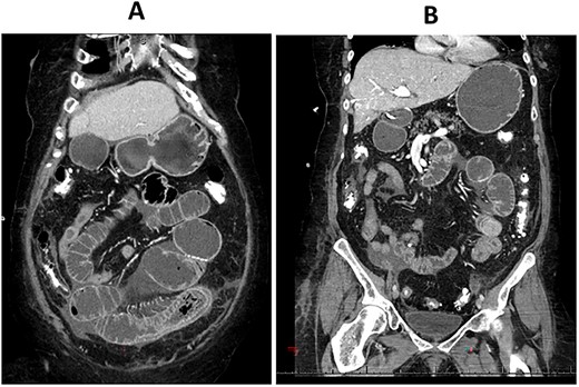 CT enterography: coronal views demonstrating dilatation of the bowel loops in the left lower quadrant associated with bowel thickening and collapsed small bowel loops distally.