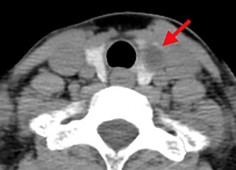 Computed tomography shows a low-density area in the left lobe of the thyroid (red arrow).