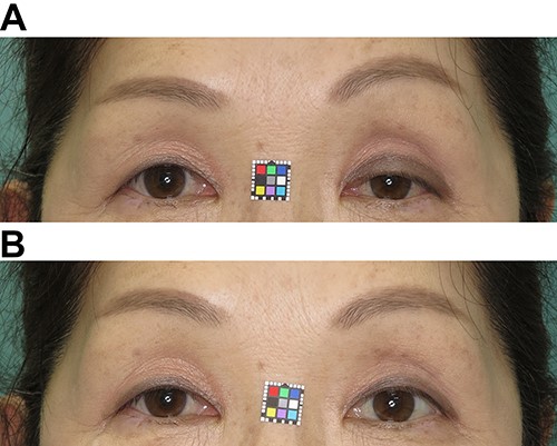 Photographs 5 months after PEI. (A) Left blepharoptosis with brow elevation caused by compensatory contraction of the frontalis muscle is observed. (B) Instillation of phenylephrine drops in the left eye improved ptosis and lowered the eyebrow that had been raised by frontalis muscle contraction.