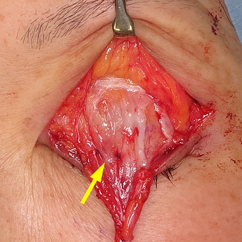Surgical technique. The aponeurosis was slightly pulled out and secured to the tarsus with two stiches of 6/0 polypropylene (yellow arrow).