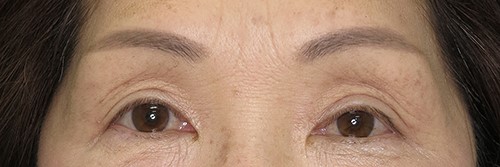 The patient at 6 months postoperatively.