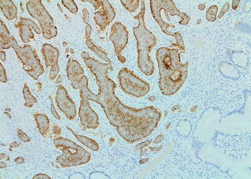 Synaptophysin stain (×100 magnification) of small bowel neuroendocrine tumor.