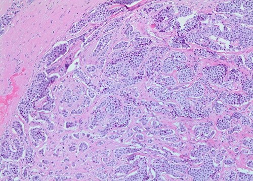 Subtotal lymph node replacement by tumor (×100 magnification).
