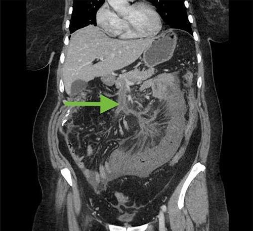 CT abdomen/pelvis 2 weeks after initial surgery demonstrating superior mesenteric vein thrombosis (arrow) and a loop of thickened small bowel consistent with ischemia.
