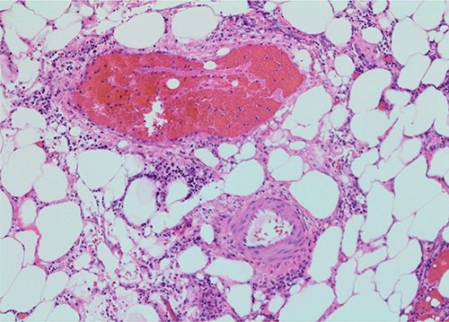 Small vein thrombosis, from initial operation (×100 magnification).
