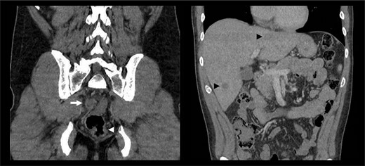 CT abdomen-pelvis with intravenous contrast demonstrating rectal wall irregularity (white arrowhead), bulky mesorectal lymphadenopathy (white arrow) and multiple hypoattenuating liver lesions (black arrow heads).