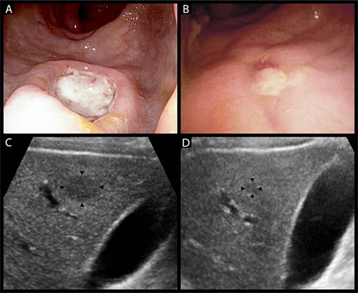 (A) heaped ulcer with a necrotic base in the lower rectum seen on colonoscopy, representing a syphilitic chancre. (B) The same lesion resolving on interval colonoscopy 4 weeks later, prior to the commencement of treatment for syphilis. (C) Hypoechoic liver lesion in segment 6 measuring 19 by 14 mm. (D) The same lesion has decreased to 6 by 5 mm at 6 weeks post-treatment.