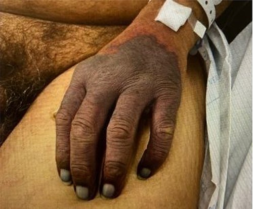 Day 6 of patient admission, necrosis of left hand.