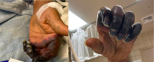 Dry gangrene of the left upper extremity.