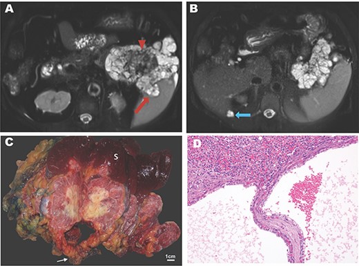 Imaging and pathology of serous cystadenocarcinoma of the pancreas. (A) T2-weighted MR image showing microcysic lesion with invasion into spleen (red arrow) and central dark scar (arrowhead) with (B) peritoneal lesion at inferior tip of the liver (blue arrow). (C) Gross specimen photograph demonstrating the large pancreatic mass (white arrow) with invasion into the spleen (S) and central necrosis (scale bar, 1 cm). (D) Photomicrograph demonstrating invasion of the splenic parenchyma (superior, H&E, 20×).