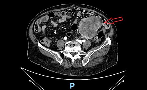 Pre-operative abdominal contrast-enhanced CT scan. Solid mass in the left pelvic quadrant originating from sigmoid mesentery, partially non-dissociable from the left round ligament, is appreciable.