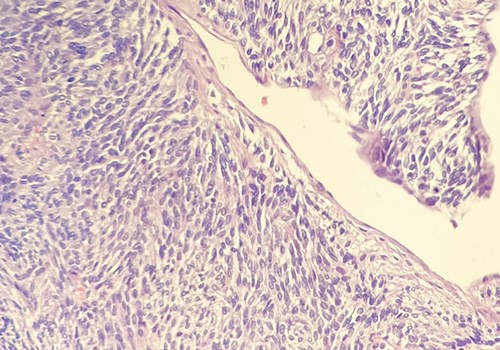 Hematossilin–eosin section showing mild–moderate cytological atypia and minimal necrosis. Courtesy of Dr Ottinetti.