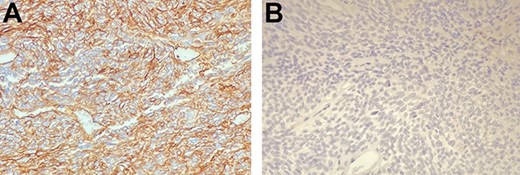 (A and B) The neoplastic cells demonstrate intense diffuse positivity for immunohistochemical staining with CD34 (A), negativity for c-Kit (B). Courtesy of Dr Ottinetti.