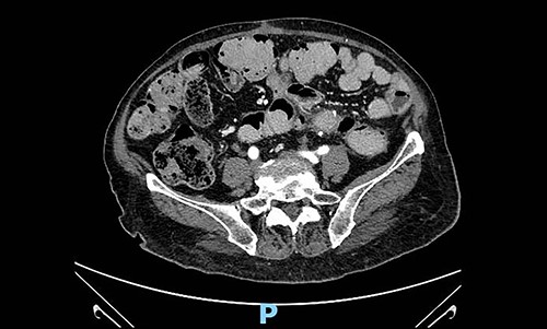 Abdominal contrast-enhanced CT scan 4 months after surgery: no evidence of local recurrence.