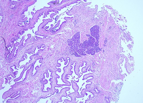 Histological examination of gallbladder ×20 showing island of ectopic pancreatic tissue adjacent to the mucosa of the gallbladder neck.