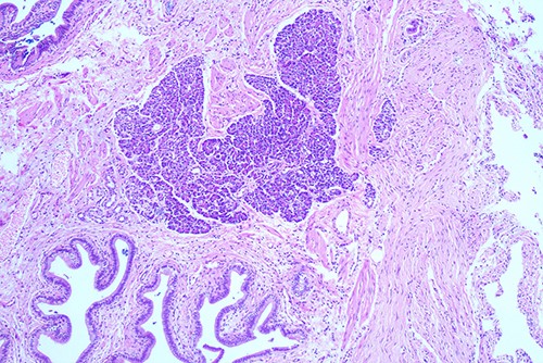 Histological examination of gallbladder ×40 showing island of ectopic pancreatic tissue adjacent to the mucosa of the gallbladder neck.