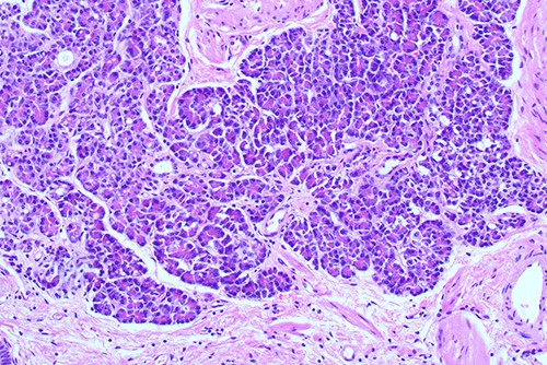 Histological examination ×100 showing ectopic tissue consisting of pancreatic acini and small ducts. No islets are seen.
