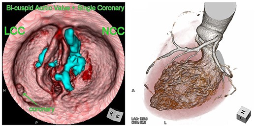 Computed tomography images of the bicuspid aortic valve type 0 and single coronary artery. Heavy calcification on NCC is indicated in blue.