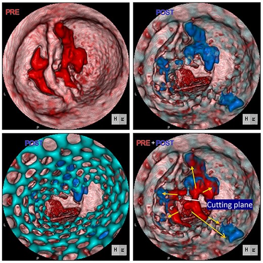 Computed tomography images of calcification before (red) and after (blue) TAVR. Distorted THV (green) at the annulus level was noted. Images were merged to detect the shifting calcification.