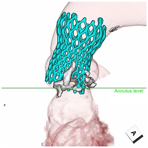 Migration of THV. Tilted prosthesis at the NCC annulus.