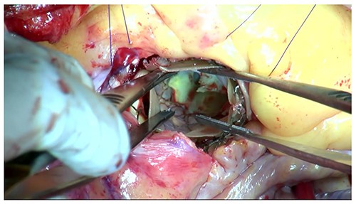 The protruding calcification into LVOT was identified in the OR.