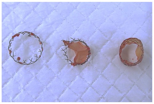 Extracted THV in pieces.