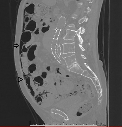 Sagittal CT image in lung window: (arrow) pneumoperitoneum and (arrow head) ‘bubbles’ within the walls of small intestine segment and the adjacent mesentery, featuring pneumatosis cystoides intestinalis and mesenteric.