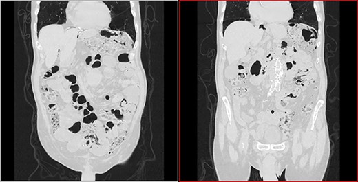Transversal CT image in lung window showing pneumoperitoneum and pneumatosis intestinalis.