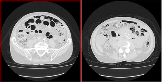 Coronal CT image in lung window showing pneumoperitoneum and ‘bubbles’ within the walls of small intestine and in the mesentery.