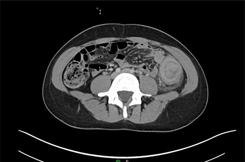 Axial CT demonstrating segmental wall thickening of the descending colon with adjacent inflammation favoring acute diverticulitis or segmental colitis.