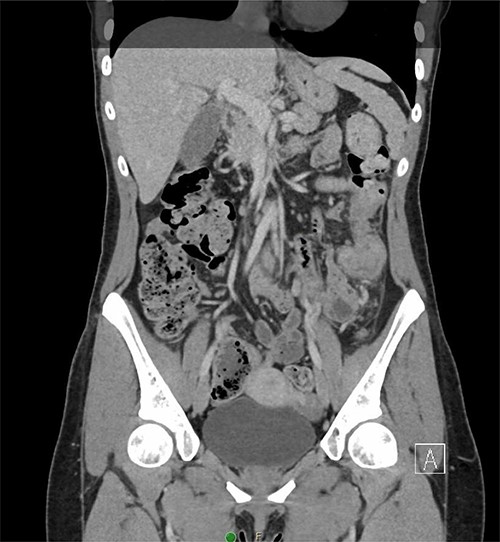 Coronal CT demonstrating segmental wall thickening of the descending colon with adjacent inflammation favoring acute diverticulitis or segmental colitis.