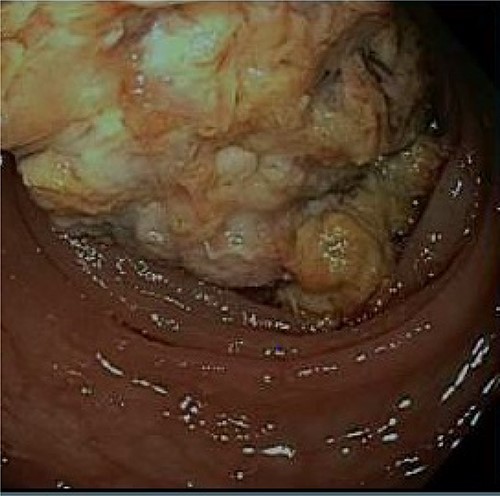 A fungating partially obstructing mass was found in the descending colon on colonoscopy.
