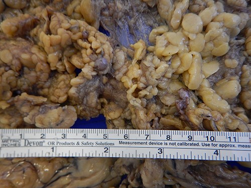 Multiple omental tumor nodules in operative specimen.