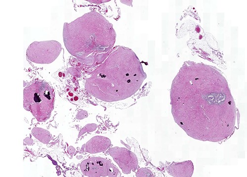 Multiple (grape-like) tumor nodules (H&E, ×2).