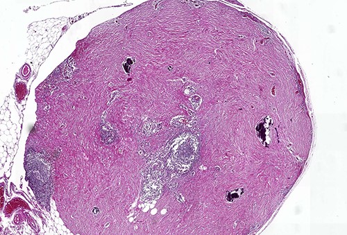 Calcifying fibrous tumor with abundant paucicellular hyalinized collagen, interspersed psammomatous or dystrophic calcifications and inflammatory infiltrate consisting of lymphocytes and plasmocytes (H&E, ×4).