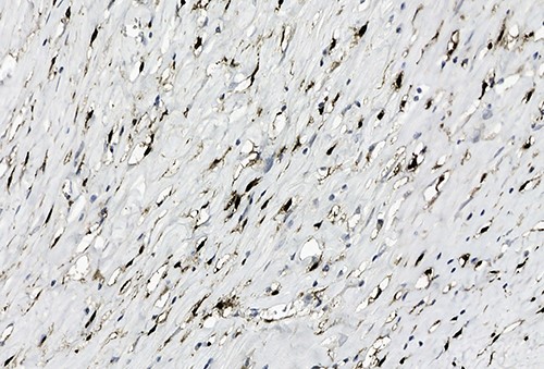 Positive staining of spindled tumor cells with Factor XIIIa, ×38.