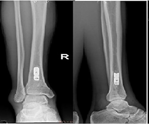 Preoperative X-ray films showing union of the right tibial fracture associated with a broken intramedullary nail remaining distal to the tibia.