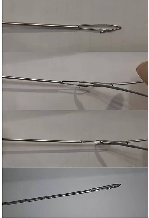 Appearance of a minimally invasive broken nail extractor. The diameter of the spear at the barb could be reduced or expanded.