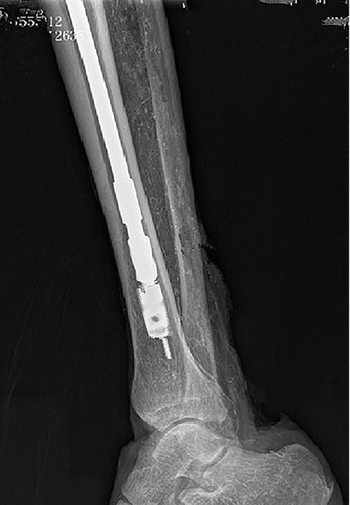 Intraoperative X-ray showing a drill used along a guide needle to ream the medullary cavity.